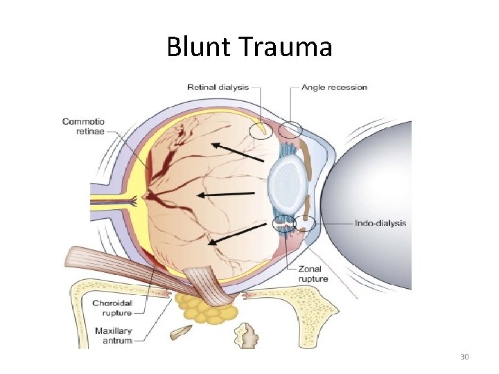 Blunt Trauma 30 Blunt Trauma 30