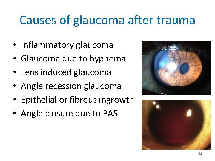 Causes of glaucoma after trauma • • • Inflammatory glaucoma Glaucoma due to hyphema Causes of glaucoma after trauma • • • Inflammatory glaucoma Glaucoma due to hyphema