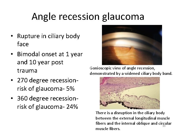 Angle recession glaucoma • Rupture in ciliary body face • Bimodal onset at 1