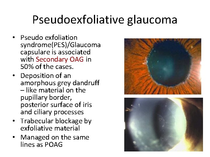 Pseudoexfoliative glaucoma • Pseudo exfoliation syndrome(PES)/Glaucoma capsulare is associated with Secondary OAG in 50%