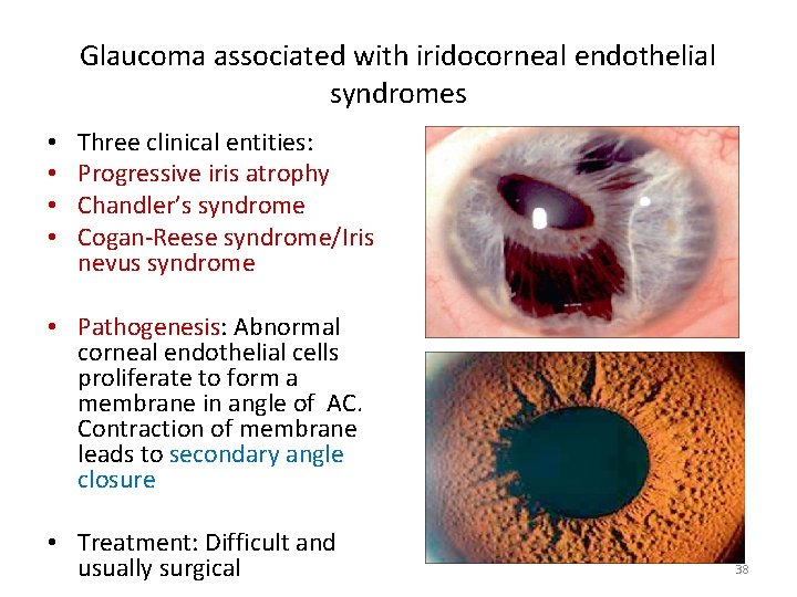 Glaucoma associated with iridocorneal endothelial syndromes • • Three clinical entities: Progressive iris atrophy