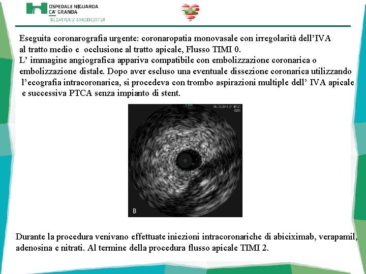 Eseguita coronarografia urgente: coronaropatia monovasale con irregolarità dell’IVA al tratto medio e occlusione al