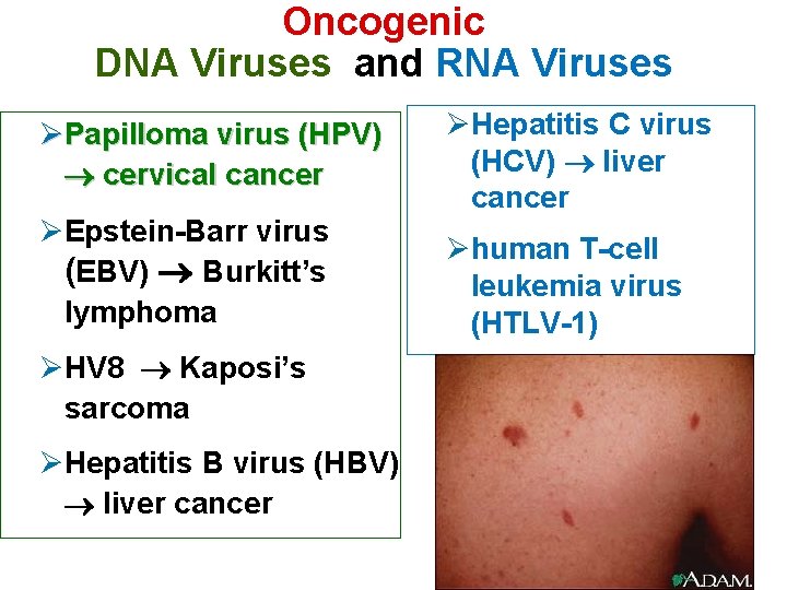 Oncogenic DNA Viruses and RNA Viruses ØPapilloma virus (HPV) cervical cancer ØEpstein-Barr virus (EBV)