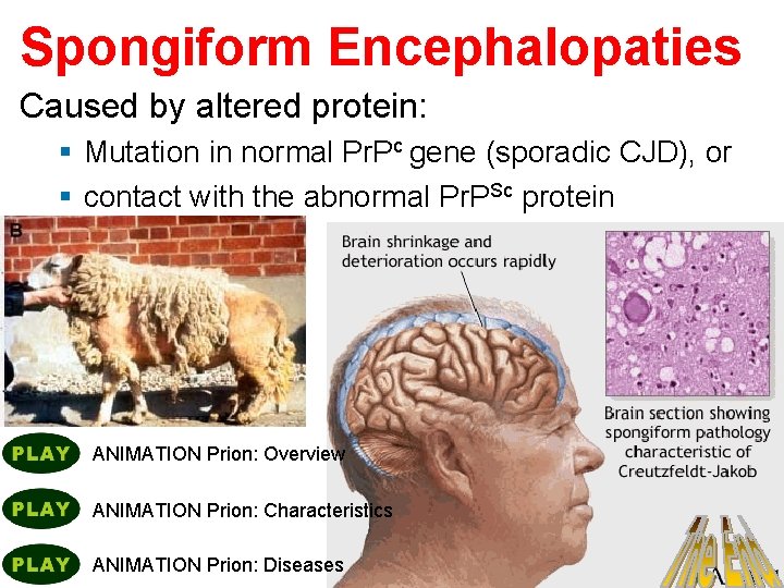 Spongiform Encephalopaties Caused by altered protein: § Mutation in normal Pr. Pc gene (sporadic