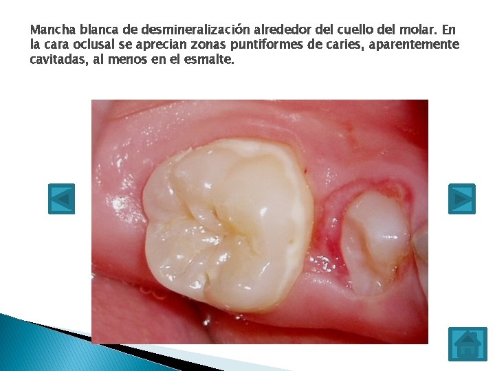 Mancha blanca de desmineralización alrededor del cuello del molar. En la cara oclusal se