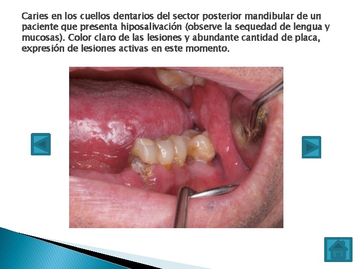 Caries en los cuellos dentarios del sector posterior mandibular de un paciente que presenta