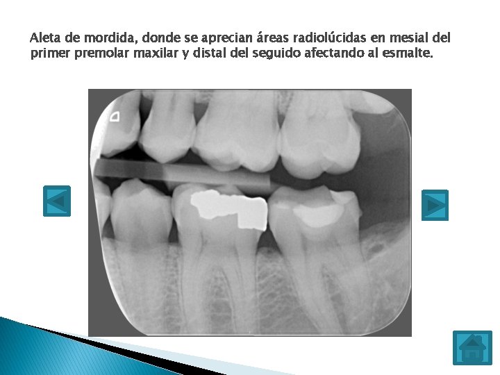 Aleta de mordida, donde se aprecian áreas radiolúcidas en mesial del primer premolar maxilar