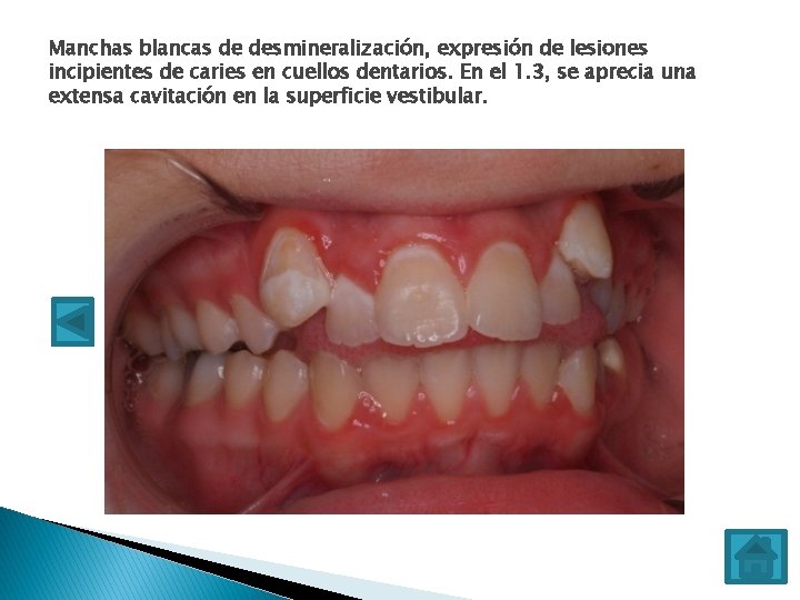 Manchas blancas de desmineralización, expresión de lesiones incipientes de caries en cuellos dentarios. En