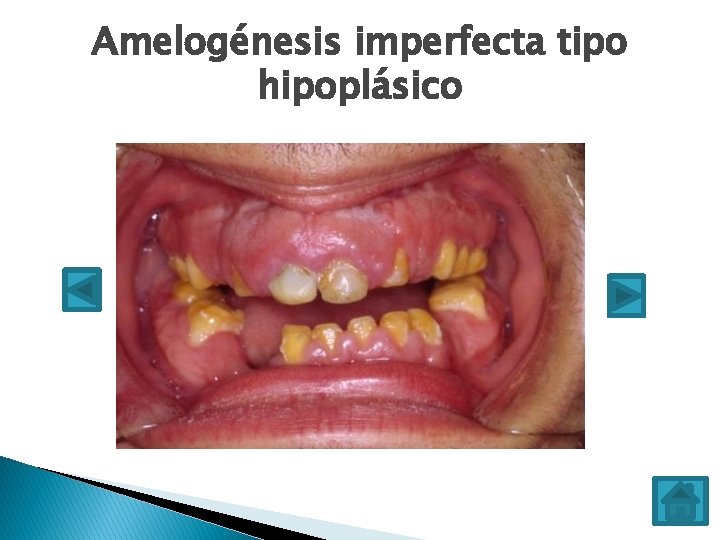 Amelogénesis imperfecta tipo hipoplásico 