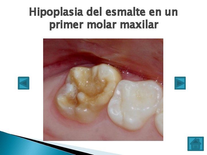 Hipoplasia del esmalte en un primer molar maxilar 