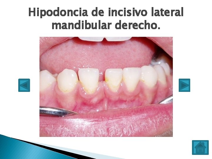 Hipodoncia de incisivo lateral mandibular derecho. 