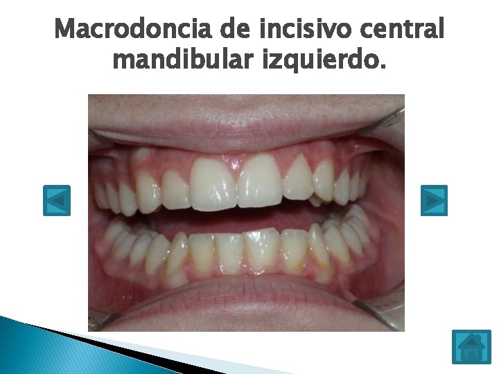 Macrodoncia de incisivo central mandibular izquierdo. 