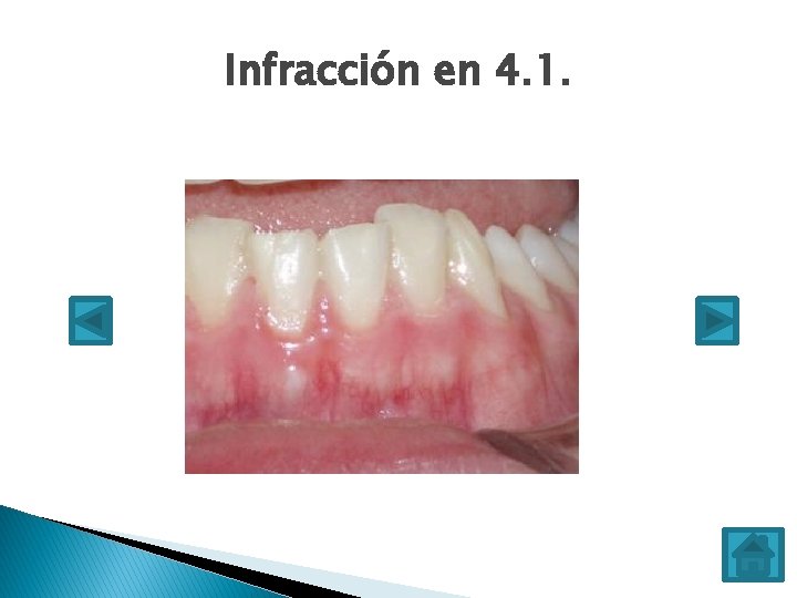 Infracción en 4. 1. 