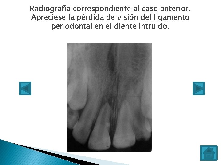 Radiografía correspondiente al caso anterior. Apreciese la pérdida de visión del ligamento periodontal en