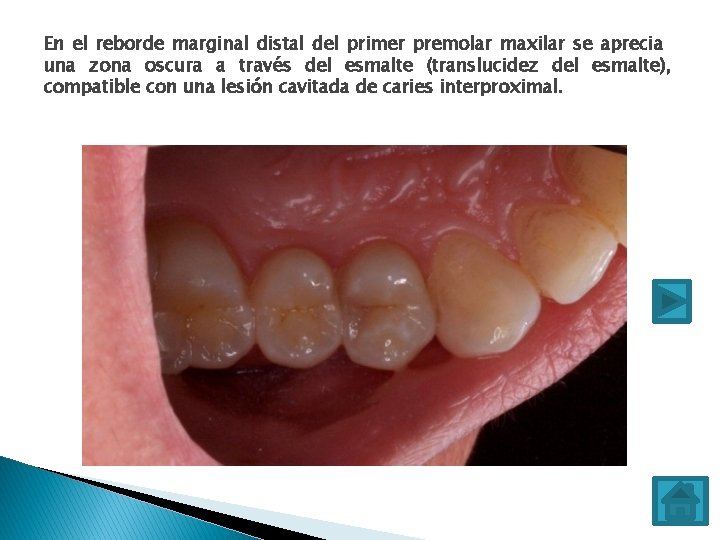 En el reborde marginal distal del primer premolar maxilar se aprecia una zona oscura