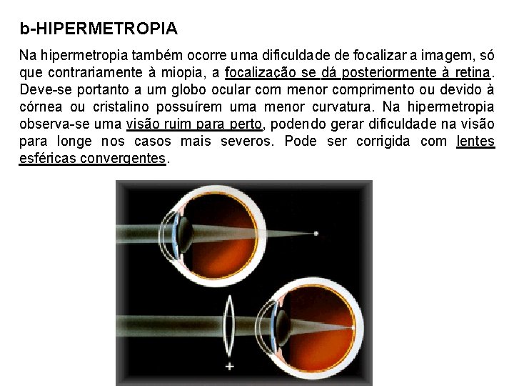 b-HIPERMETROPIA Na hipermetropia também ocorre uma dificuldade de focalizar a imagem, só que contrariamente