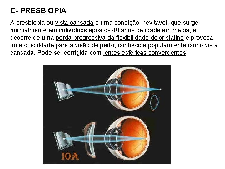 C- PRESBIOPIA A presbiopia ou vista cansada é uma condição inevitável, que surge normalmente