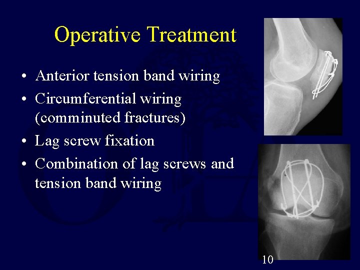 Operative Treatment • Anterior tension band wiring • Circumferential wiring (comminuted fractures) • Lag