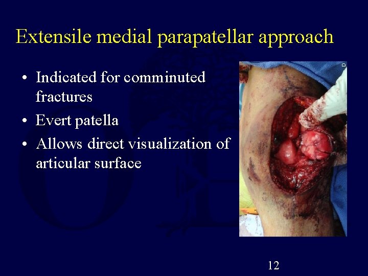 Extensile medial parapatellar approach • Indicated for comminuted fractures • Evert patella • Allows