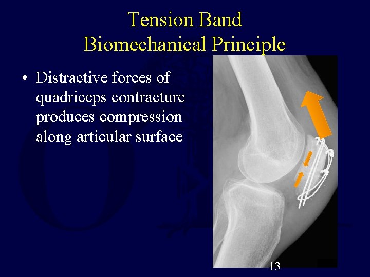 Tension Band Biomechanical Principle • Distractive forces of quadriceps contracture produces compression along articular