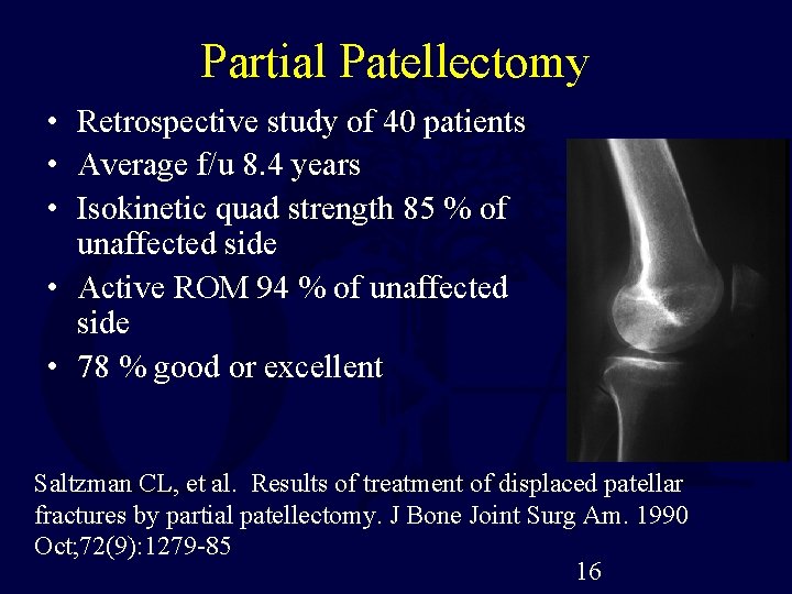 Partial Patellectomy • Retrospective study of 40 patients • Average f/u 8. 4 years