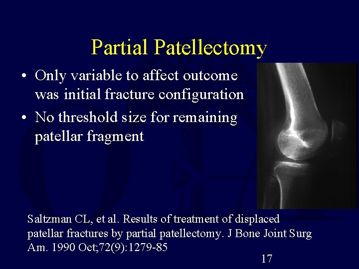 Partial Patellectomy • Only variable to affect outcome was initial fracture configuration • No
