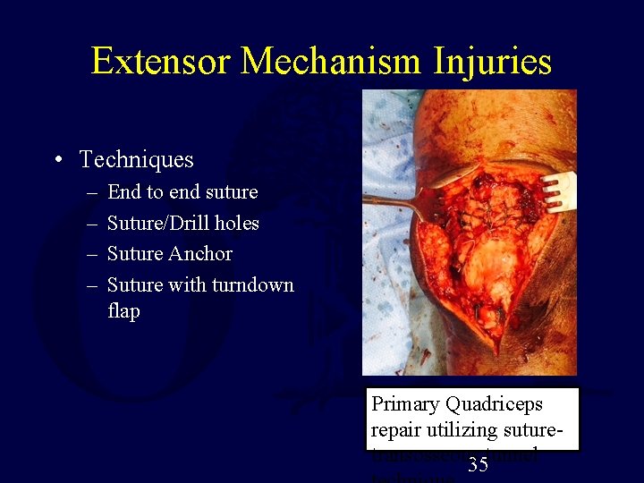 Extensor Mechanism Injuries • Techniques – – End to end suture Suture/Drill holes Suture