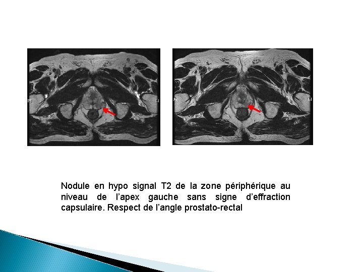 Nodule en hypo signal T 2 de la zone périphérique au niveau de l’apex Nodule en hypo signal T 2 de la zone périphérique au niveau de l’apex