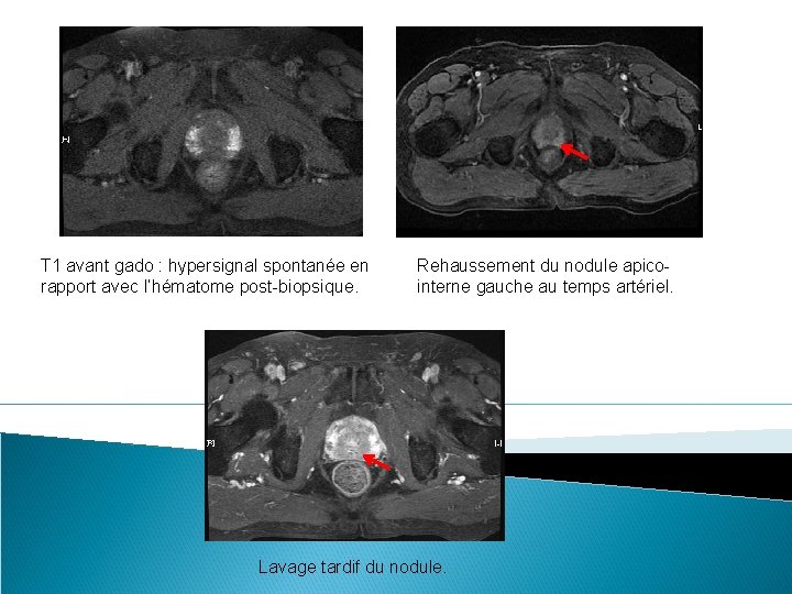 T 1 avant gado : hypersignal spontanée en rapport avec l’hématome post-biopsique. Rehaussement du T 1 avant gado : hypersignal spontanée en rapport avec l’hématome post-biopsique. Rehaussement du
