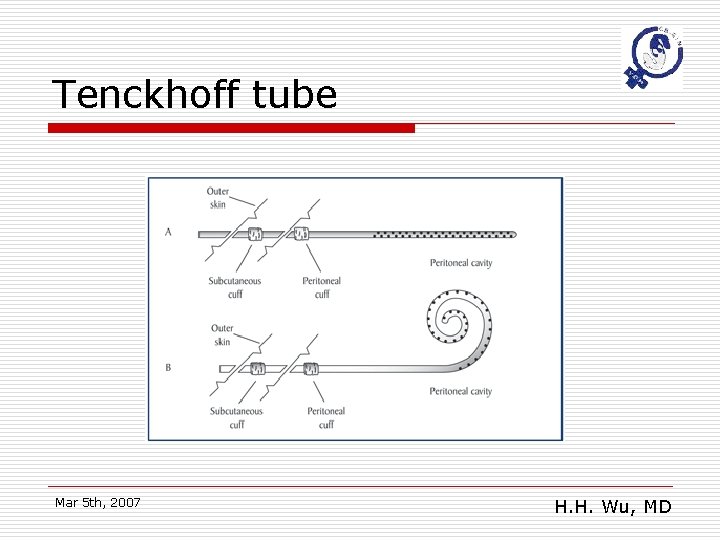 Tenckhoff tube Mar 5 th, 2007 H. H. Wu, MD 