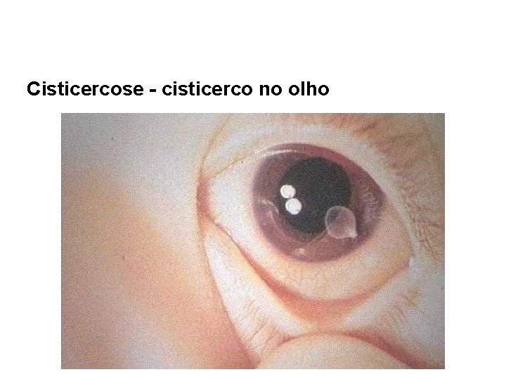 Cisticercose - cisticerco no olho 