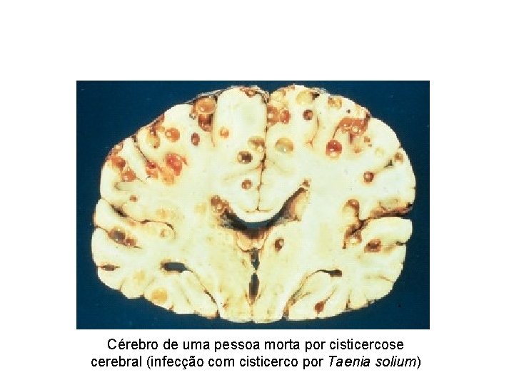 Cérebro de uma pessoa morta por cisticercose cerebral (infecção com cisticerco por Taenia solium)