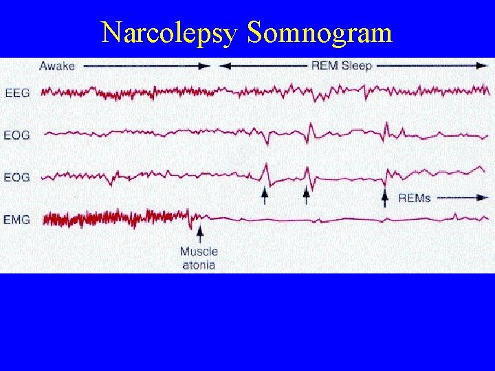 Narcolepsy Somnogram 