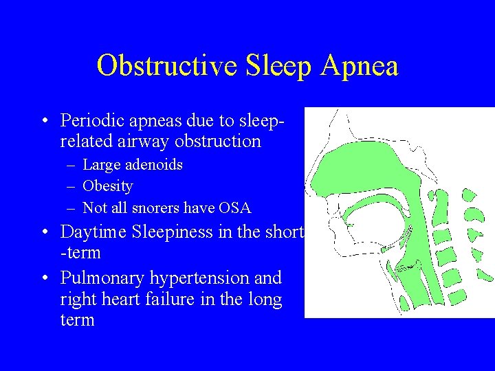 Obstructive Sleep Apnea • Periodic apneas due to sleeprelated airway obstruction – Large adenoids