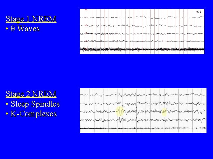 Stage 1 NREM • Waves Stage 2 NREM • Sleep Spindles • K-Complexes 
