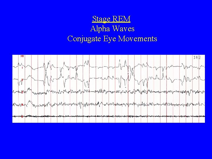 Stage REM Alpha Waves Conjugate Eye Movements 