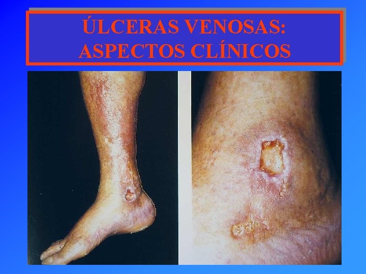 ÚLCERAS VENOSAS: ASPECTOS CLÍNICOS 