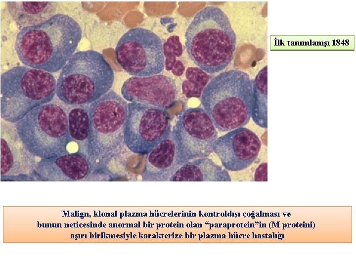 İlk tanımlanışı 1848 Malign, klonal plazma hücrelerinin kontroldışı çoğalması ve bunun neticesinde anormal bir