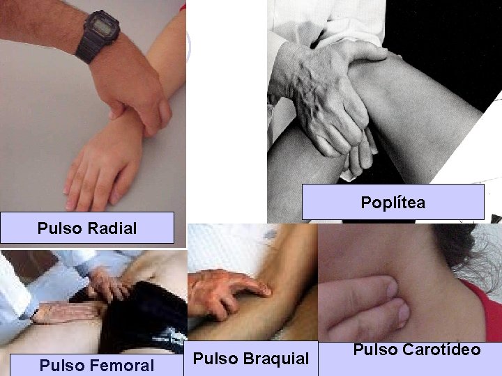 Poplítea Pulso Radial Pulso Femoral Pulso Braquial l. Pulso Carotídeo 