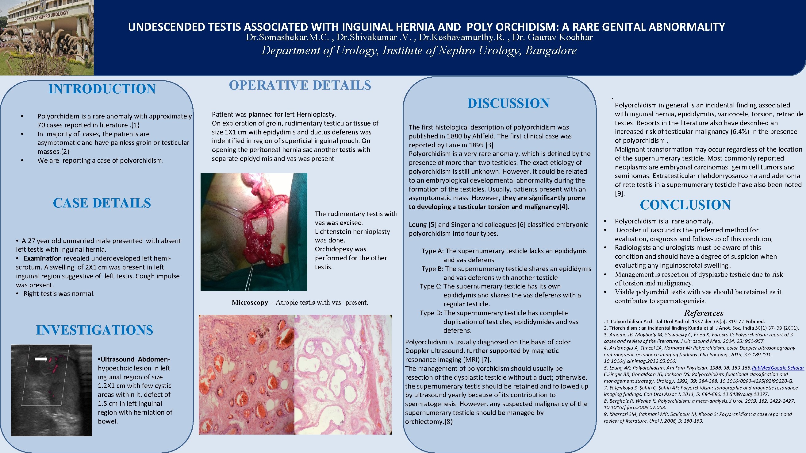 UNDESCENDED TESTIS ASSOCIATED WITH INGUINAL HERNIA AND POLY ORCHIDISM: A RARE GENITAL ABNORMALITY Dr.