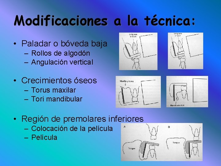 Modificaciones a la técnica: • Paladar o bóveda baja – Rollos de algodón –