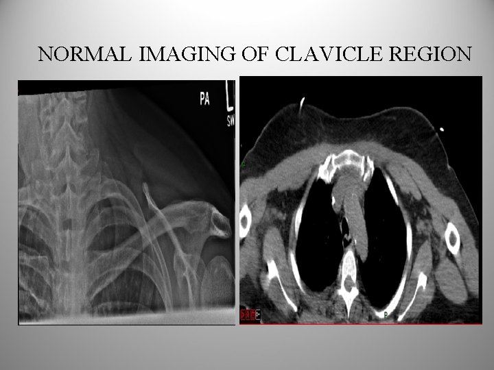 NORMAL IMAGING OF CLAVICLE REGION 