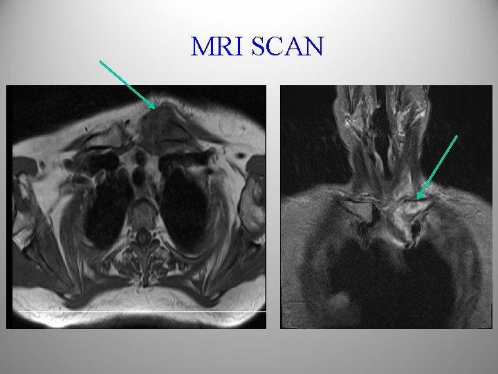 MRI SCAN 