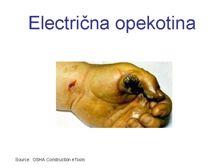 Electrična opekotina Source: OSHA Construction e. Tools 