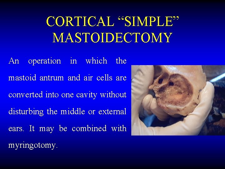 CORTICAL “SIMPLE” MASTOIDECTOMY An operation in which the mastoid antrum and air cells are