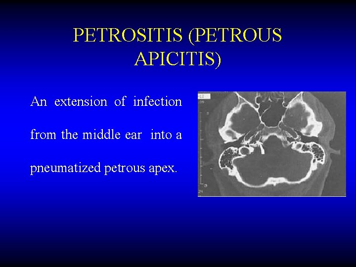 PETROSITIS (PETROUS APICITIS) An extension of infection from the middle ear into a pneumatized