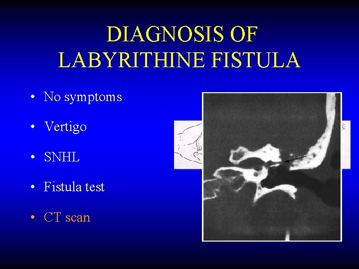 DIAGNOSIS OF LABYRITHINE FISTULA • No symptoms • Vertigo • SNHL • Fistula test
