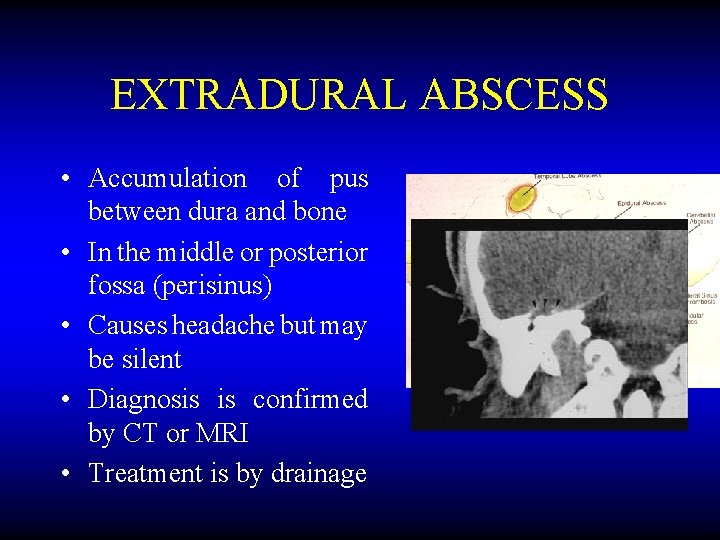 EXTRADURAL ABSCESS • Accumulation of pus between dura and bone • In the middle