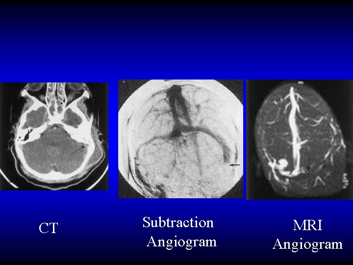 CT Subtraction Angiogram MRI Angiogram 