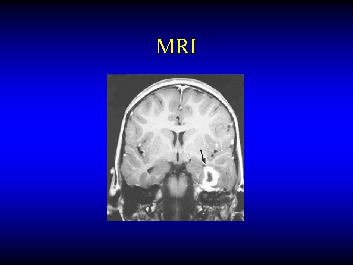 MRI 